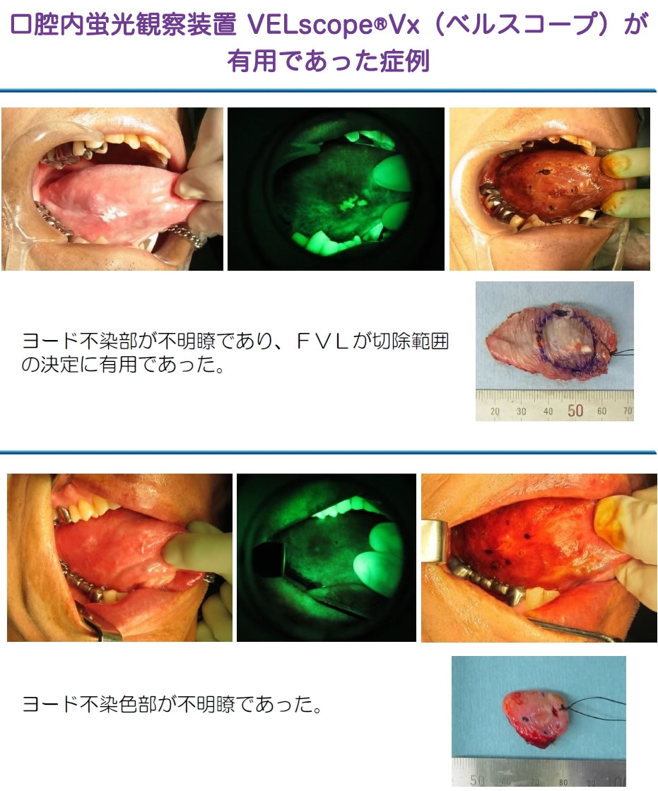 http://www.oralcancer.jp/%E6%9C%89%E7%94%A8%E7%97%87%E4%BE%8B.jpg