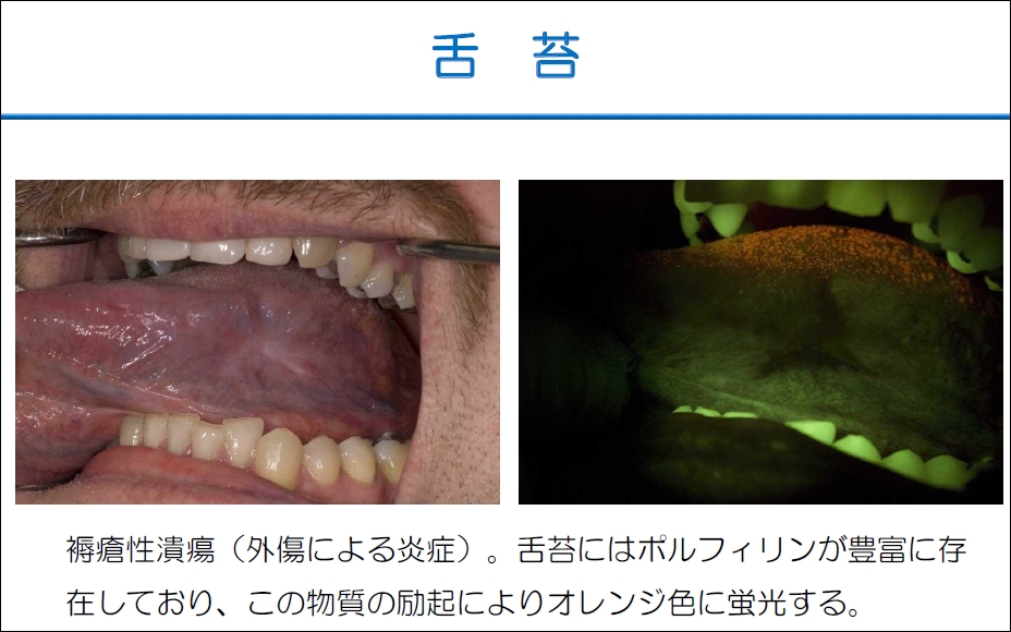 http://www.oralcancer.jp/%E8%88%8C%E8%8B%94%E3%80%80line.jpg