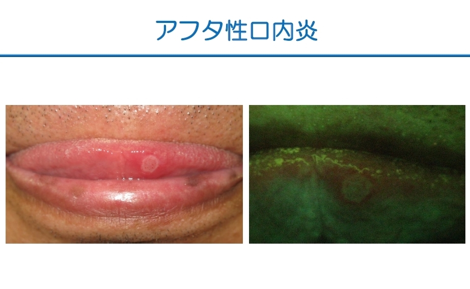 http://www.oralcancer.jp/VELscope%20%E3%82%A2%E3%83%95%E3%82%BF%E6%80%A7%E5%8F%A3%E5%86%85%E7%82%8E1-1.jpg