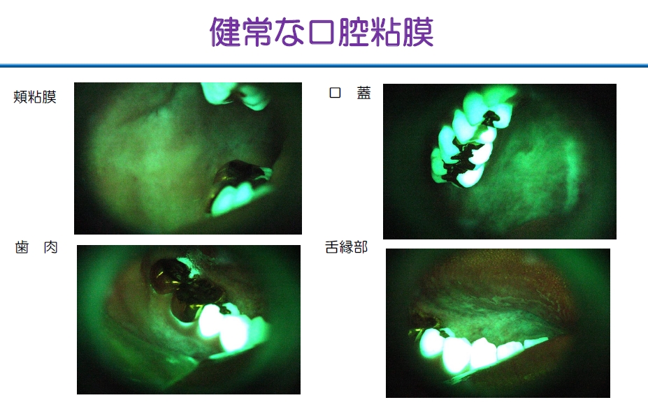 http://www.oralcancer.jp/VELscope%20%E5%81%A5%E5%B8%B8%E5%8F%A3%E8%85%94%E7%B2%98%E8%86%9C.jpg