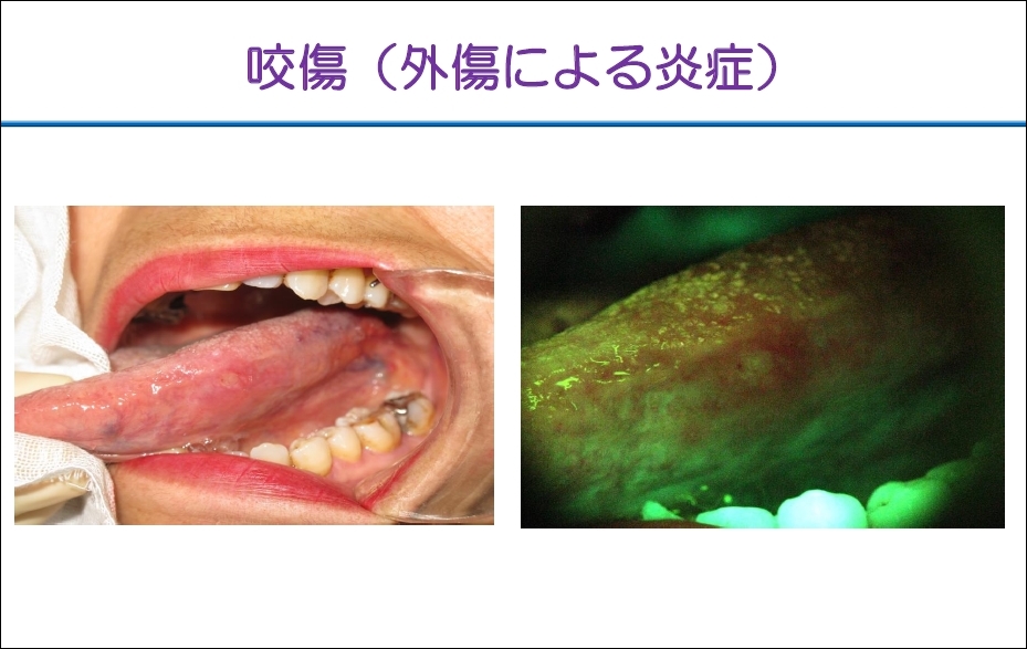 http://www.oralcancer.jp/VELscope%20%E5%92%AC%E5%82%B7.jpg