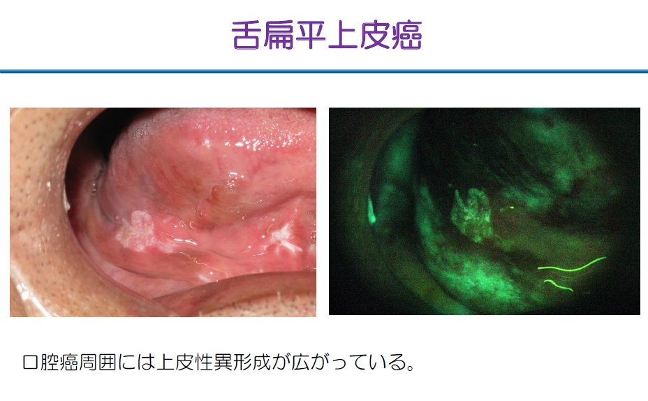 http://www.oralcancer.jp/VELscope%20%E6%89%81%E5%B9%B3%E4%B8%8A%E7%9A%AE%E7%99%8C%EF%BC%91.jpg