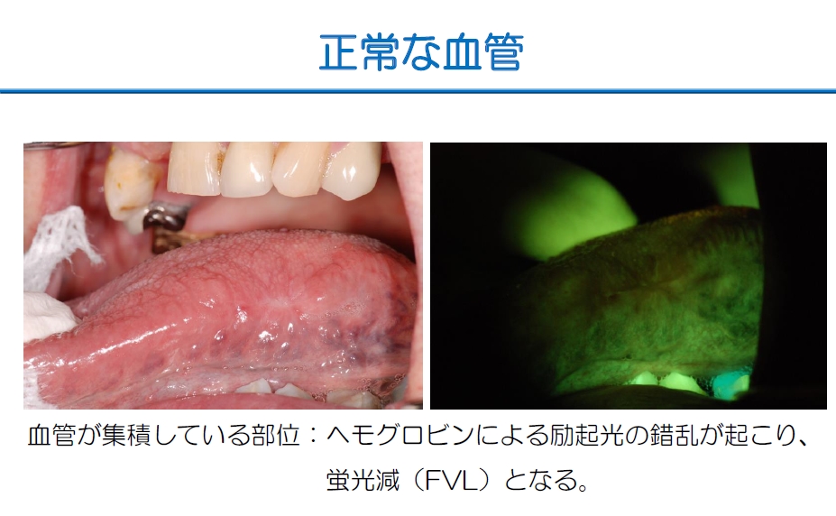 http://www.oralcancer.jp/VELscope%20%E6%AD%A3%E5%B8%B8%E3%81%AA%E8%A1%80%E7%AE%A1.jpg