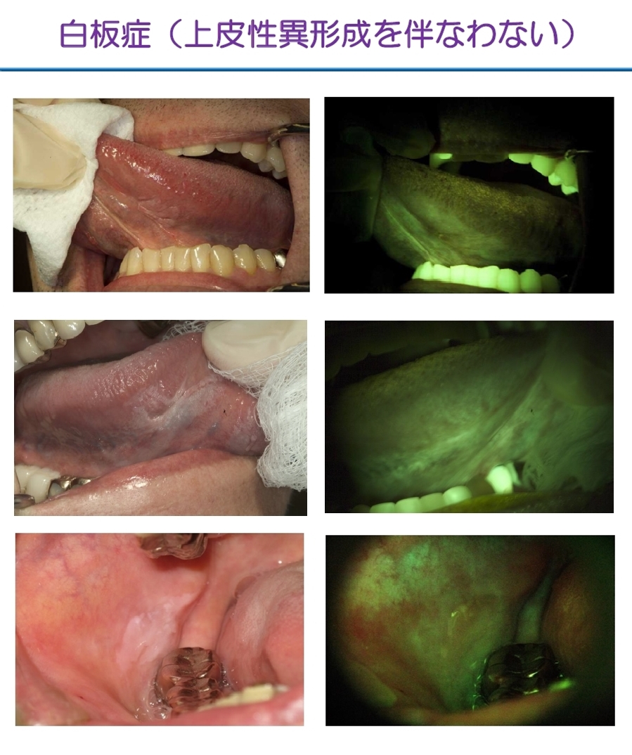 http://www.oralcancer.jp/VELscope%20%E7%99%BD%E6%9D%BF%E7%97%873-1.jpg