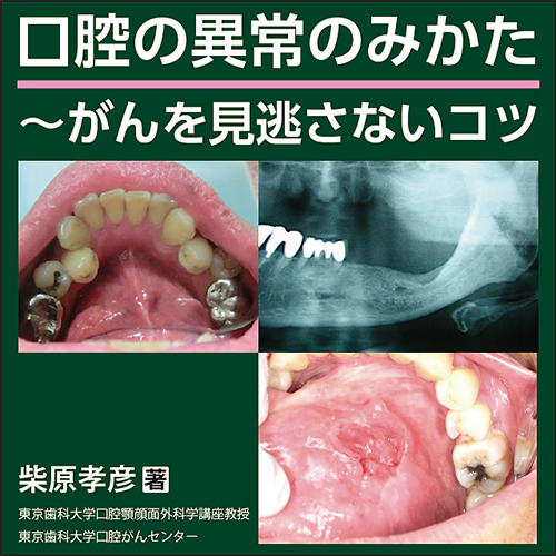 口腔の異常のみかた～がんを見逃さないコツ