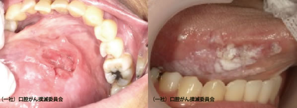 口腔がんでは扁平上皮癌が全体の90%以上を占める