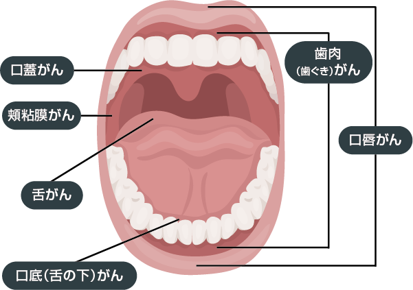 口腔がんの好発部位