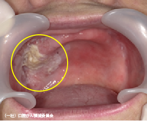 義歯（入れ歯）の刺激が原因で発癌した可能性のある症例（上顎）