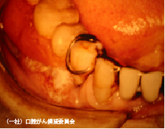 局部床義歯（入れ歯）下の歯肉癌