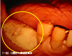 局部床義歯（入れ歯）下の歯肉癌